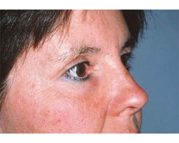 Eyelid Surgery before and after photo