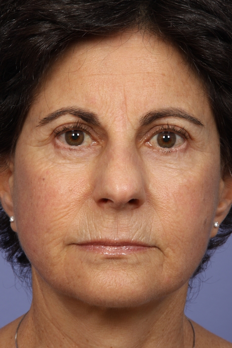 Eyelid Surgery before and after photo