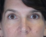 Eyelid Surgery