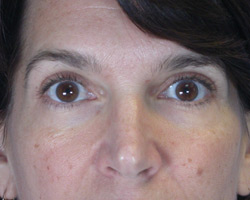 Eyelid Surgery before and after photo