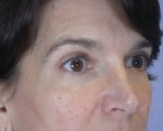 Eyelid Surgery