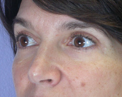 Eyelid Surgery before and after photo