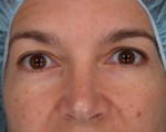 Eyelid Surgery Before and after photo