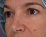 Eyelid Surgery Before and after photo