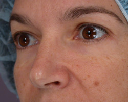 Eyelid Surgery before and after photo