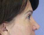 Eyelid Surgery Before and after photo