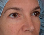 Eyelid Surgery