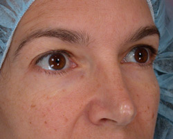 Eyelid Surgery before and after photo