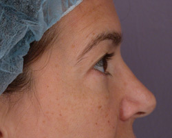 Eyelid Surgery before and after photo