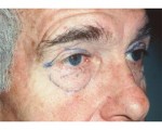 Eyelid Surgery Before and after photo