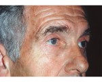 Eyelid Surgery