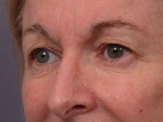 Eyelid Surgery Before and after photo