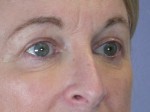 Eyelid Surgery Before and after photo