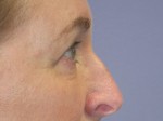 Eyelid Surgery Before and after photo