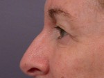 Eyelid Surgery Before and after photo