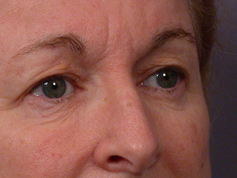 Eyelid Surgery before and after photo