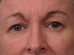 Eyelid Surgery Before and after photo