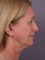 Eyelid Surgery Before and after photo