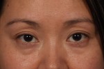 Injectable Fillers Before and after photo