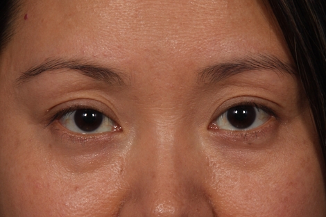 Injectable Fillers before and after photo