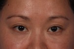 Injectable Fillers Before and after photo