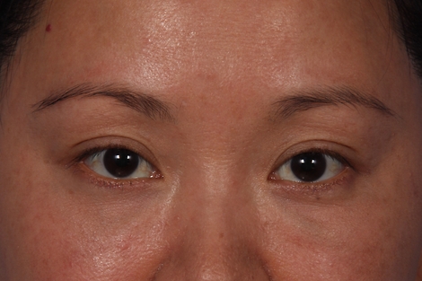 Injectable Fillers before and after photo
