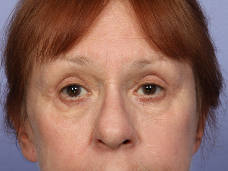 Eyelid Surgery before and after photo