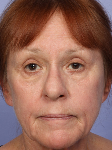 Eyelid Surgery before and after photo