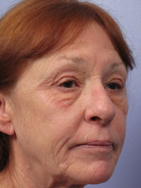 Eyelid Surgery before and after photo