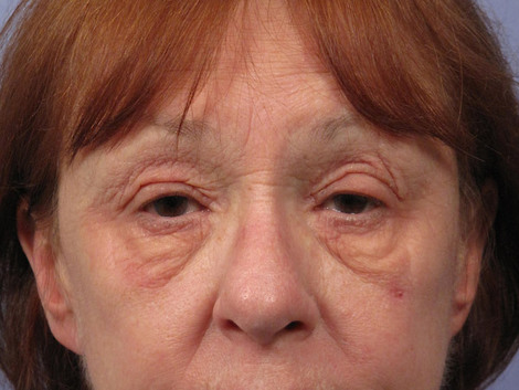 Eyelid Surgery before and after photo