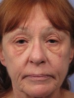 Eyelid Surgery Before and after photo