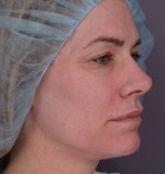 Eyelid Surgery Before and after photo