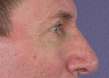 Eyelid Surgery before and after photo