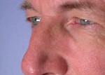 Eyelid Surgery