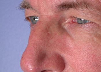 Eyelid Surgery before and after photo