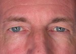 Eyelid Surgery Before and after photo