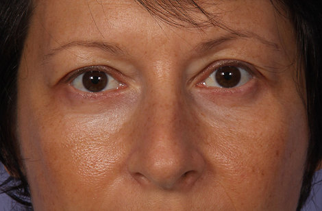 Eyelid Surgery before and after photo