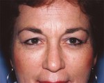 Eyelid Surgery Before and after photo