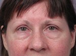 Eyelid Surgery Before and after photo