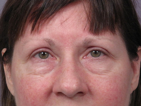 Eyelid Surgery before and after photo