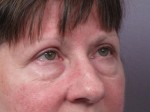 Eyelid Surgery Before and after photo