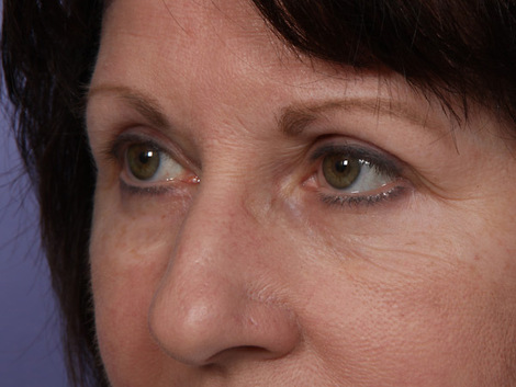 Eyelid Surgery before and after photo