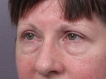 Eyelid Surgery Before and after photo