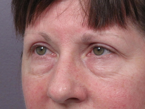 Eyelid Surgery before and after photo