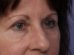 Eyelid Surgery Before and after photo