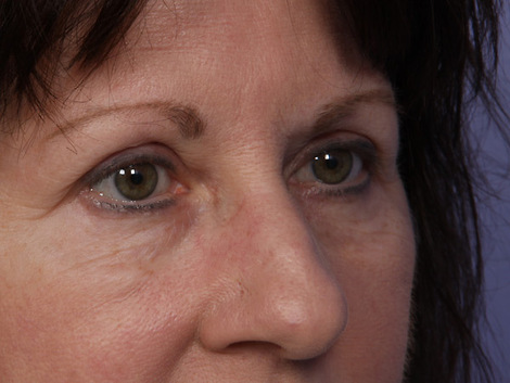 Eyelid Surgery before and after photo