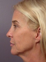 Eyelid Surgery Before and after photo