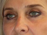 Eyelid Surgery Before and after photo