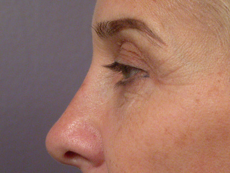 Eyelid Surgery before and after photo