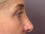 Eyelid Surgery Before and after photo